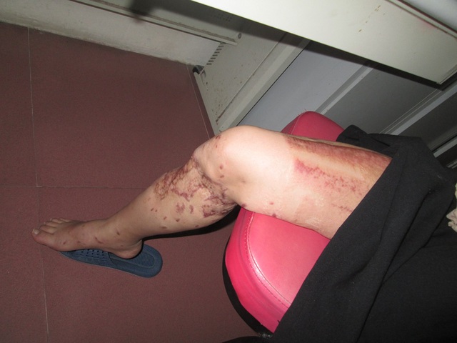 
Chân phải đã được cắt đi nhiều cơ, sau đó phải xử lí da bị bong lóc và dùng da để che phủ. Ảnh: Ngọc Thi
