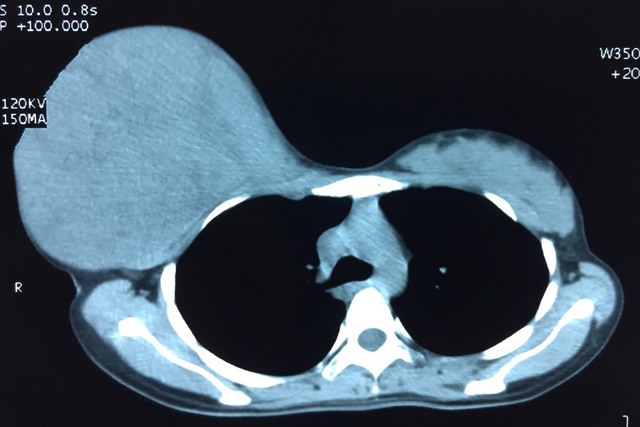 
Hình ảnh chụp Xquang cho thấy sự phát triển của khối u khổng lồ.
