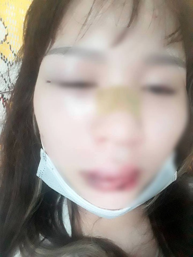 Giúp người bị thương thiếu nữ bị đánh lệch sống mũi
