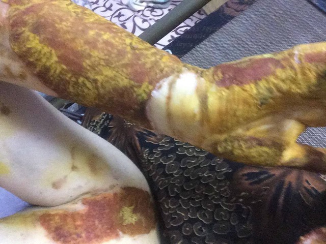 
Vết bỏng tr&ecirc;n tay D.A do vụ nổ ở Ph&ograve;ng thực h&agrave;nh H&oacute;a học g&acirc;y ra.
