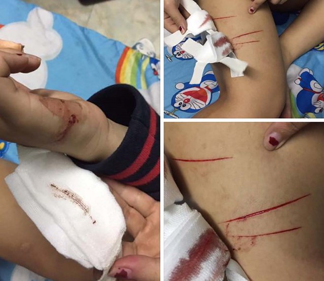 Nữ sinh 19 tuổi bị rạch 3 nh&aacute;t v&agrave;o đ&ugrave;i, 1 nh&aacute;t v&agrave;o tay phải. Ảnh:Nạn nh&acirc;n cung cấp.