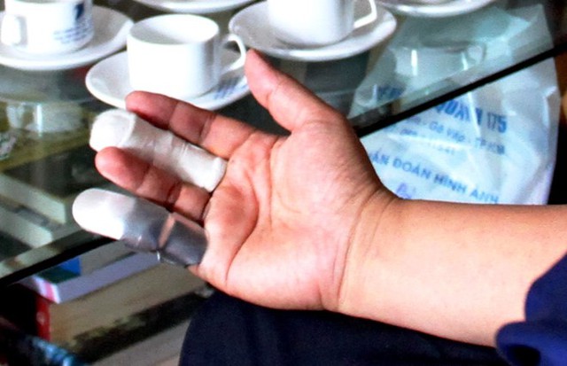 Hai ng&oacute;n tr&ecirc;n b&agrave;n tay phải của &ocirc;ng Đ&ocirc;ng bị g&atilde;y. Ảnh: Hải Hiếu.