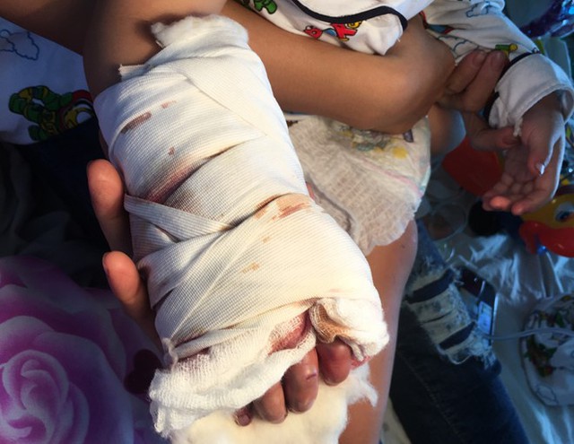 Bàn tay cháu bé bị thang máy ở sân bay Tân Sơn Nhất kẹp dập nát. Ảnh: Bác sĩ cung cấp.