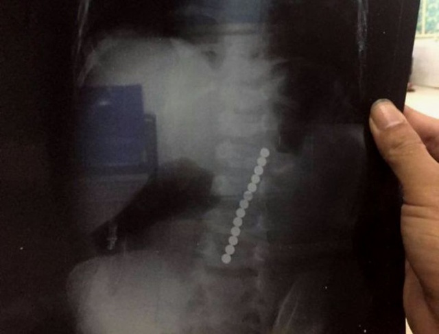 Hình ảnh trên phim chụp X-quang cho thấy 13 viên bi trong dạ dày cháu bé. (Ảnh bệnh viện đa khoa Đô Lương, Nghệ An)