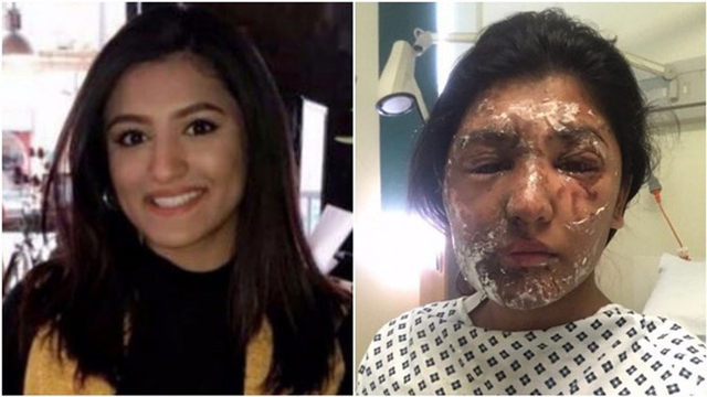 
Cô gái Resham Khan, 21 tuổi trước và sau khi bị tạt a xít.
