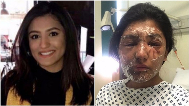 
C&ocirc; g&aacute;i Resham Khan, 21 tuổi trước v&agrave; sau khi bị tạt a x&iacute;t.
