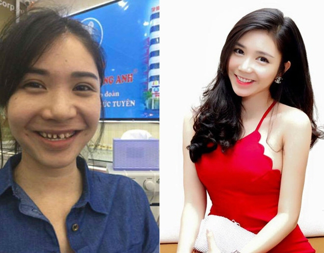 
Hình ảnh trước khi làm răng của Thanh Bi gây chú ý trên mạng xã hội.
