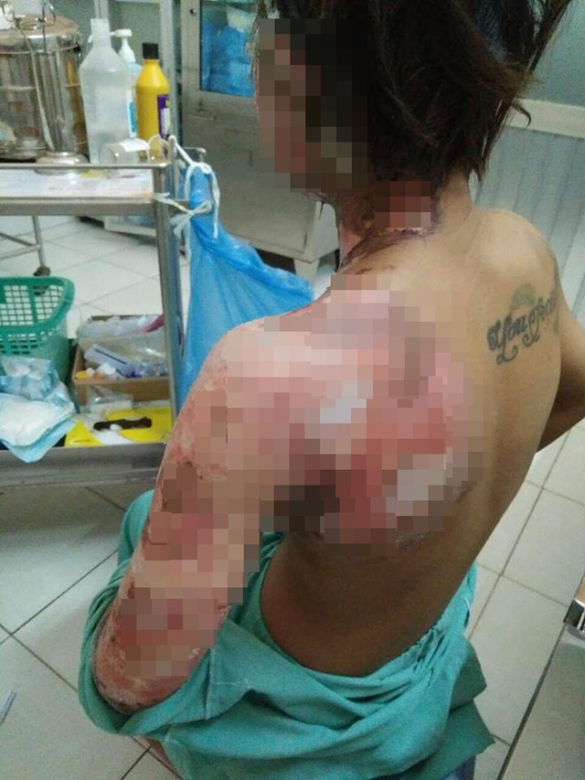 V&ugrave;ng tay v&agrave; cổ của nạn nh&acirc;n nữ bị bỏng nặng.