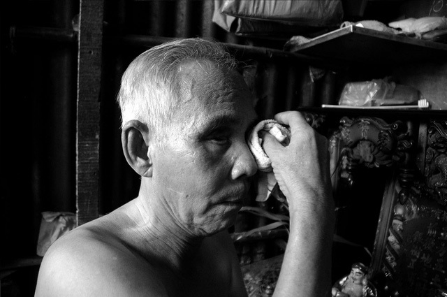 Bị tai biến sau căn bệnh đậu m&ugrave;a năm 9 tuổi khiến đ&ocirc;i mắt của &ocirc;ng Quang kh&ocirc;ng c&ograve;n nh&igrave;n thấy.