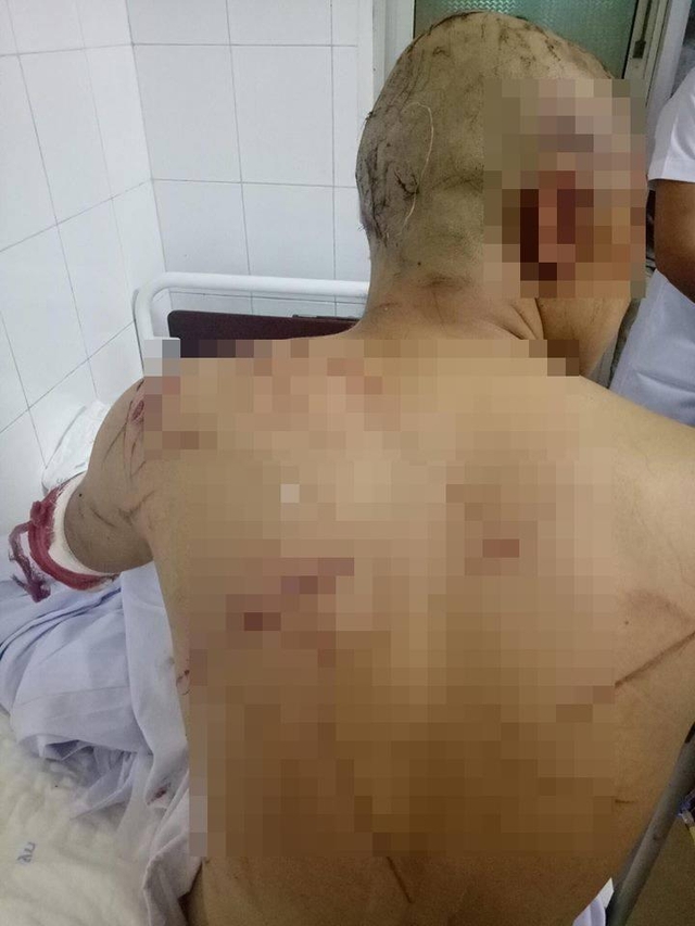 Cơ thể anh H&ugrave;ng d&agrave;y đặc vết thương sau vụ truy s&aacute;t
