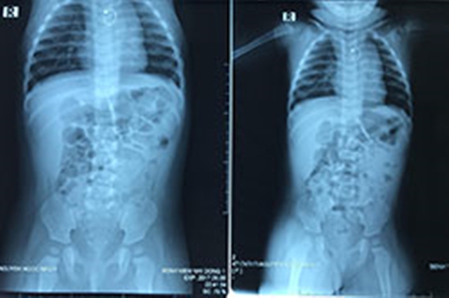Ảnh chụp X-quang cho thấy chiếc hoa tai bị lọt vào vùng thực quản đứa trẻ.