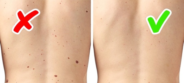 
Xuất hiện nhiều nốt ruồi trên da cũng có iểu hiện trên da cảnh báo bệnh ung thư da.
