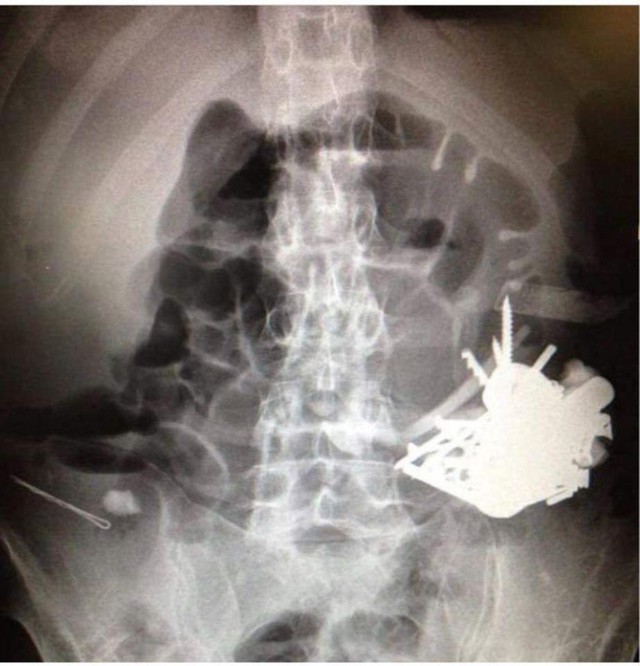 
Hình ảnh chụp khối dị vật trong dạ dày bệnh nhân.
