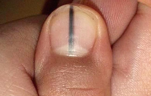 
Vết sọc đen trên móng tay có thể nghiêm trọng hơn bạn nghĩ rất nhiều.
