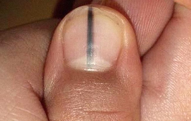 Vết sọc đen trên móng tay có thể nghiêm trọng hơn bạn nghĩ rất nhiều.
