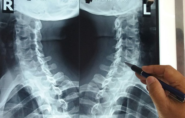 Thường các bệnh lý thoái hóa đốt sống cổ ở người trẻ do những chèn ép tác động lên sụn khớp cổ vùng gáy. Ảnh: Bệnh viện cung cấp