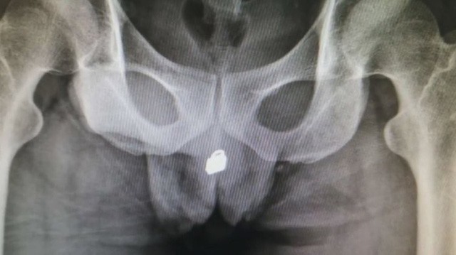 Kết quả chụp X-quang gây sốc: Chiếc khóa đã kẹt lại bàng quang của bệnh nhân.
