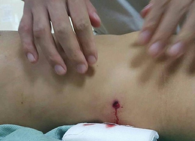 
Viên đạn xuyên thủng vùng bụng của nạn nhân.
