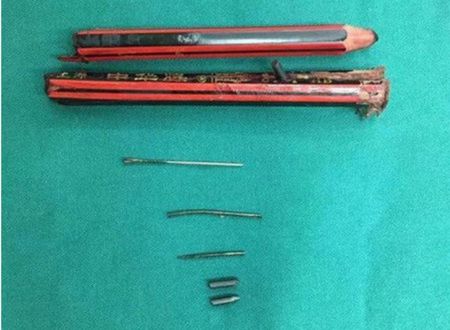Những dị vật đ&acirc;m v&agrave;o cổ b&eacute; g&aacute;i gồm 2 mẩu b&uacute;t ch&igrave; v&agrave; 3 c&acirc;y kim.