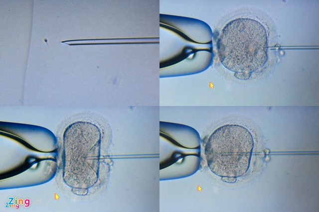 
Cận cảnh quá trình thụ tinh trong ống nghiệm (tiêm tinh trùng trực tiếp vào bào tương noãn). Ảnh: Việt Hùng.
