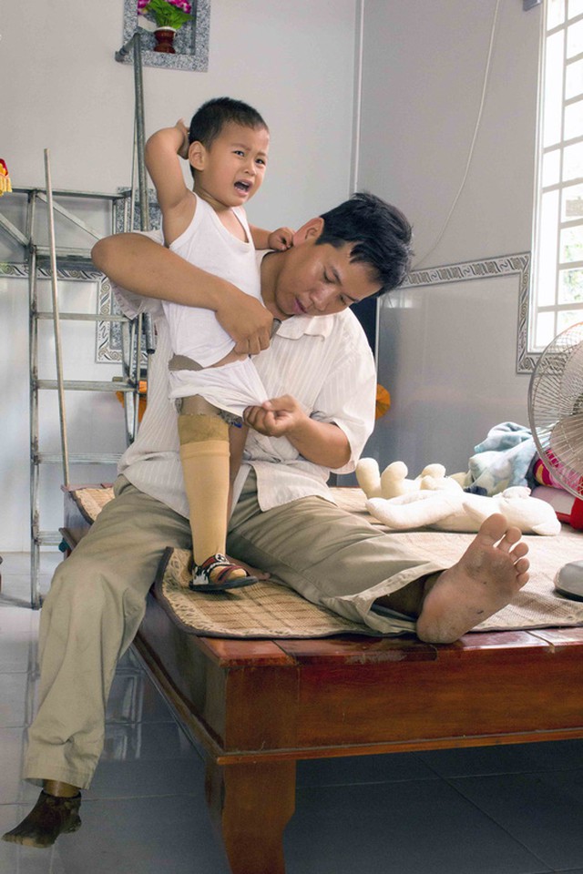 Đ&ocirc;i ch&acirc;n giả khiến b&eacute; Huy đ&ocirc;i khi cảm thấy kh&oacute; chịu