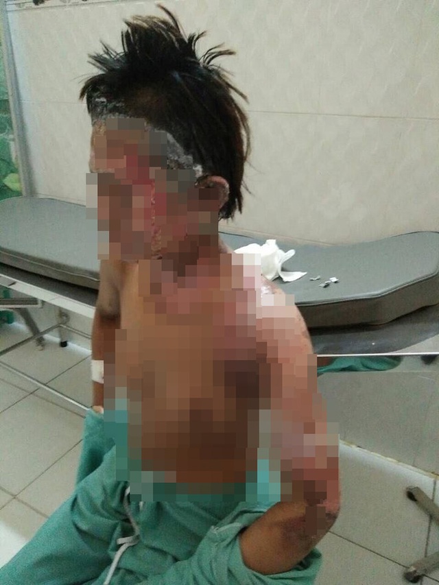 Người vợ bị bỏng s&acirc;u tỉ lệ 10%.