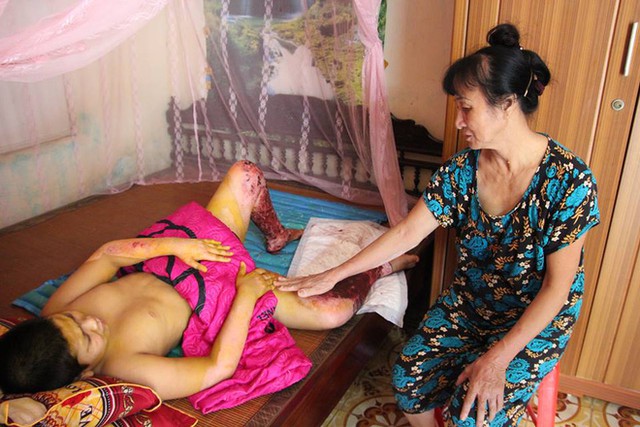 Ch&aacute;u Nguyễn Mạnh H&ugrave;ng (11 tuổi bị nặng nặng hơn anh cũng đ&atilde; tạm ổn định sức khỏe)