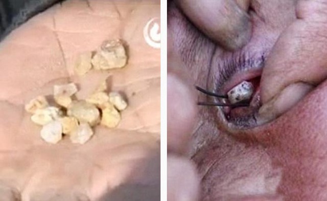 
Trước đ&oacute; c&oacute; người phụ nữ c&ograve;n... kh&oacute;c ra sỏi.
