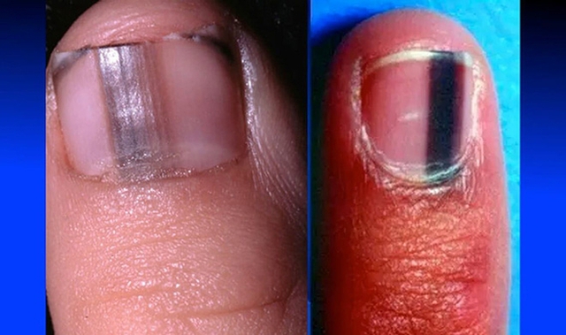 
Nail melanoma được gọi là u hắc tố dưới móng, u ác tính dưới da, hay còn gọi là ung thư da.
