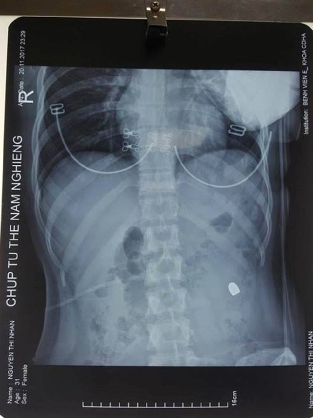 
Phim chụp X-quang cho thấy viên đạn nằm sâu trong bụng nạn nhân.
