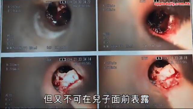 C&aacute;c b&aacute;c sĩ đ&atilde; tiến h&agrave;nh phẫu thuật v&agrave; lấy ra được một mẩu tẩy b&uacute;t ch&igrave; từ trong tai phải cậu b&eacute;.