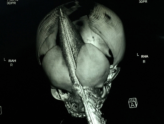 Ngày 8/8/2015, bé Dương Minh Phát 11 ngày tuổi ở Vĩnh Long được đưa đến Bệnh viện Nhi Đồng 1 trong tình trạng con dao cắm lút cán vào trán. Gia đình cho biết, bé đang điều trị nội trú tại khoa Nhi, Bệnh viện Đa khoa Vĩnh Long thì bị một người phụ nữ lạ mặt đâm.Các bác sĩ Bệnh viện Nhi Đồng 1 đã phẫu thuật lấy con dao ra khỏi não của bé thành công. Phần cắm vào não đi từ hốc mắt trái, xuyên lên não phải ước tính khoảng 11 cm. Đây là lần đầu tiên bệnh viện này tiếp nhận ca bệnh nhi sơ sinh bị dao đâm xuyên sọ. Dù được cứu sống thành công, các bác sĩ vẫn cảnh báo các biến chứng có thể xảy ra trong 2 năm đầu.