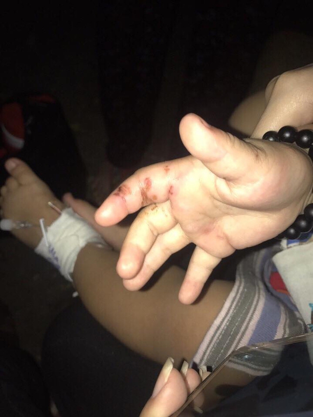 Vết cắn ở tay, thương tích trên chân đứa bé 2 tuổi.
