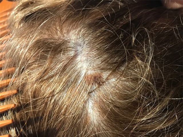 
Nốt ruồi bất thường trên da đầu Korey. (Ảnh: Internet)
