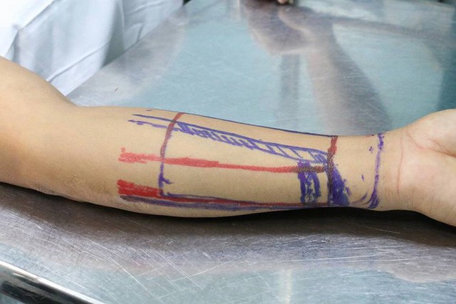 Bệnh nhân được sử dụng vạt da cánh tay để ghép cho dương vật.