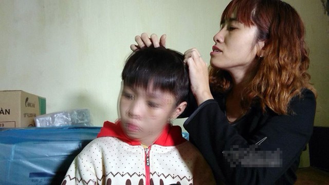 Vết đỏ dài trên đầu cháu bé nghi bị bố và mẹ kế bạo hành. Ảnh: Đoàn Bổng