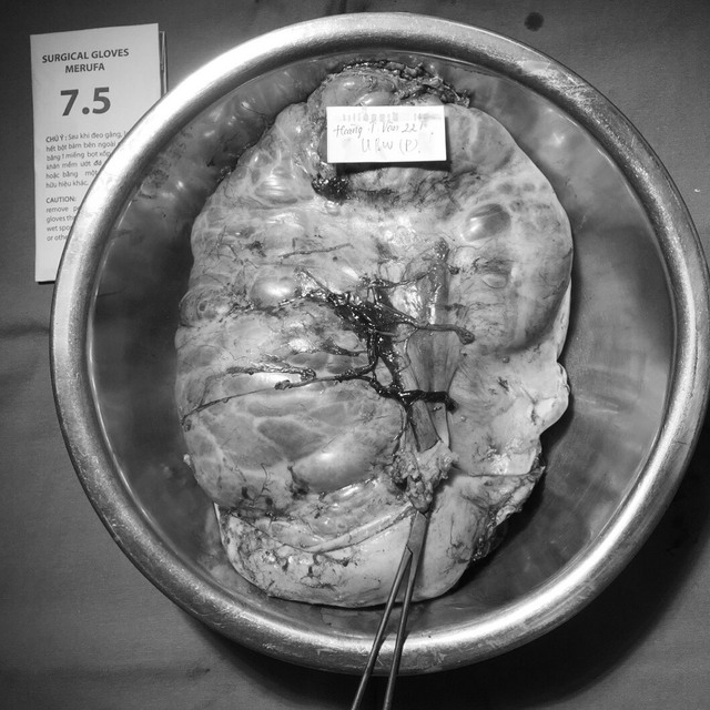 Hình ảnh khối u nặng 16kg được lấy ra từ bụng bệnh nhân
