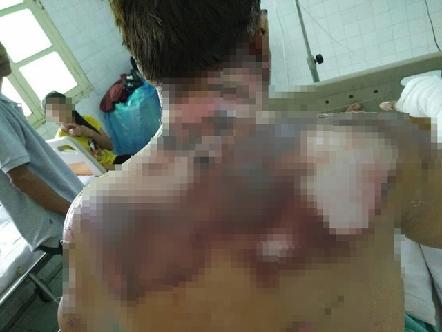 Cả hai nạn nh&acirc;n đều bị bỏng s&acirc;u k&egrave;m bỏng h&ocirc; hấp.