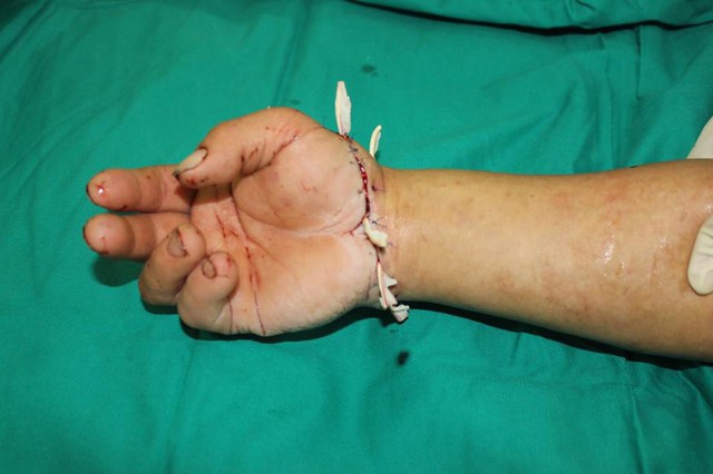 Cánh tay của bệnh nhân đã hồng ấm và phản hồi mao mạch tốt sau 3 ngày được các bác sĩ ghép nối
