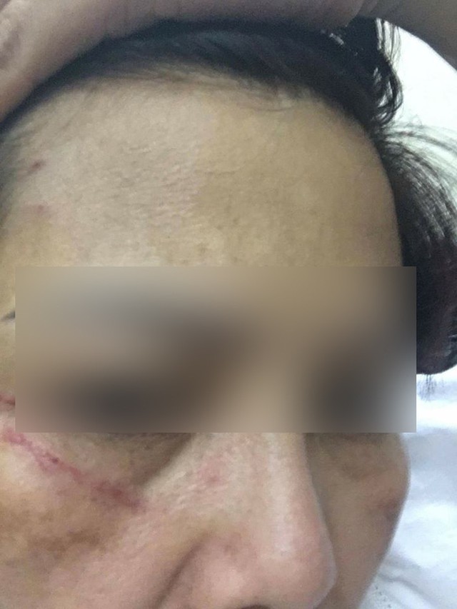 Chị Th. tố bị một kh&aacute;ch h&agrave;ng kh&aacute;c đ&aacute;nh r&aacute;ch 5cm tr&ecirc;n mặt ngay tại ng&acirc;n h&agrave;ng