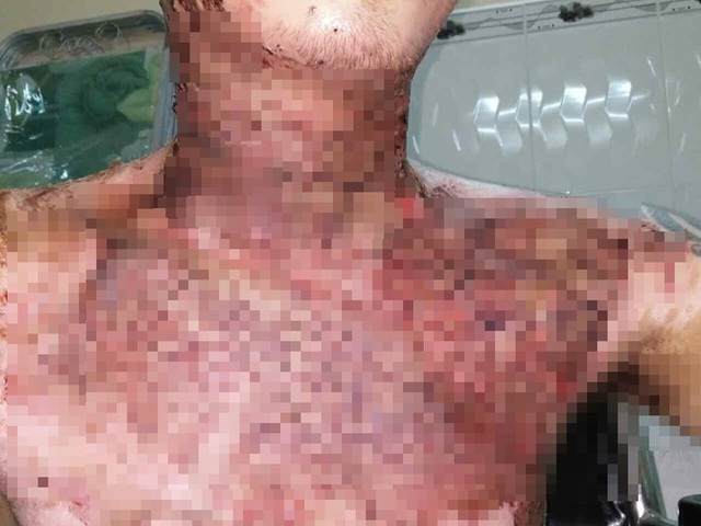 Lần gh&eacute;p da đầu ti&ecirc;n cho nam bệnh nh&acirc;n.