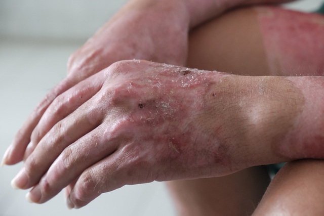 Tay anh T. đ&atilde; phục hồi sau qu&aacute; tr&igrave;nh điều trị.