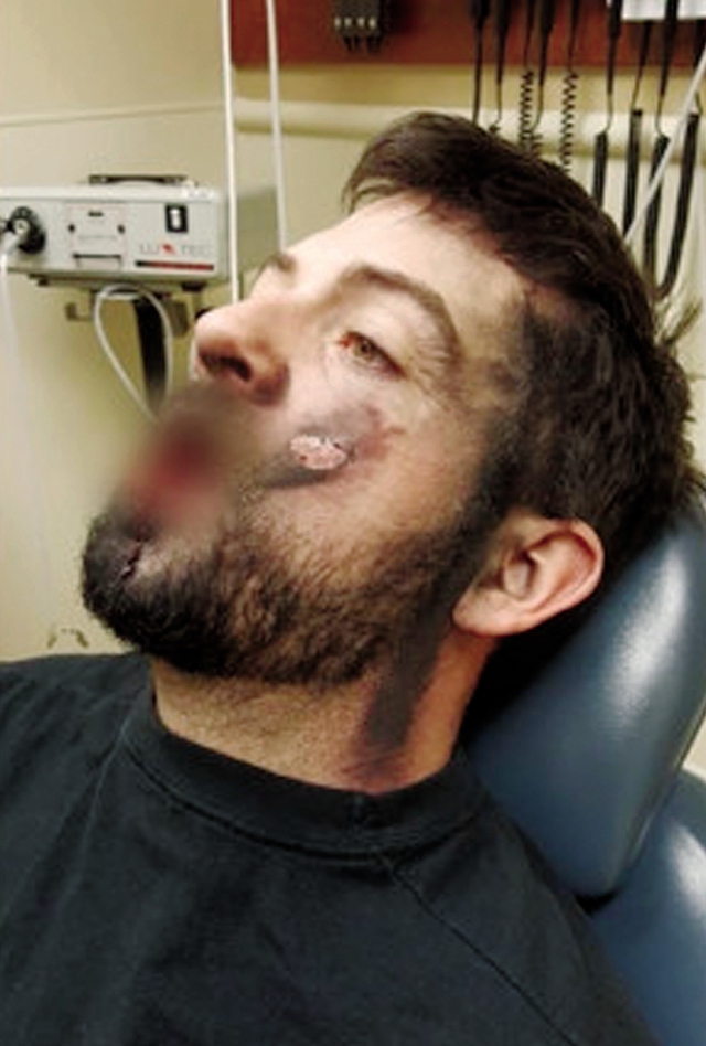 
Anh Andrew Hall đang được điều trị do thuốc lá điện tử phát nổ.

