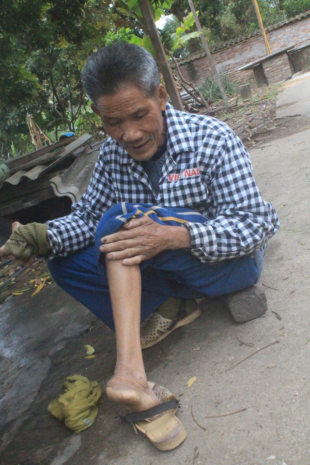
Ông Lê Văn Quý 75 tuổi quê ở Hà Nội. Sau ngày mắc bệnh, vợ và gia đình xa lánh, ông vào trại phong từ những năm sau giải phóng đất nước. Người anh cả của ông là ông Lê Văn Cộng năm nay đã 95 tuổi cũng bị bệnh phong và ở cùng ông.
