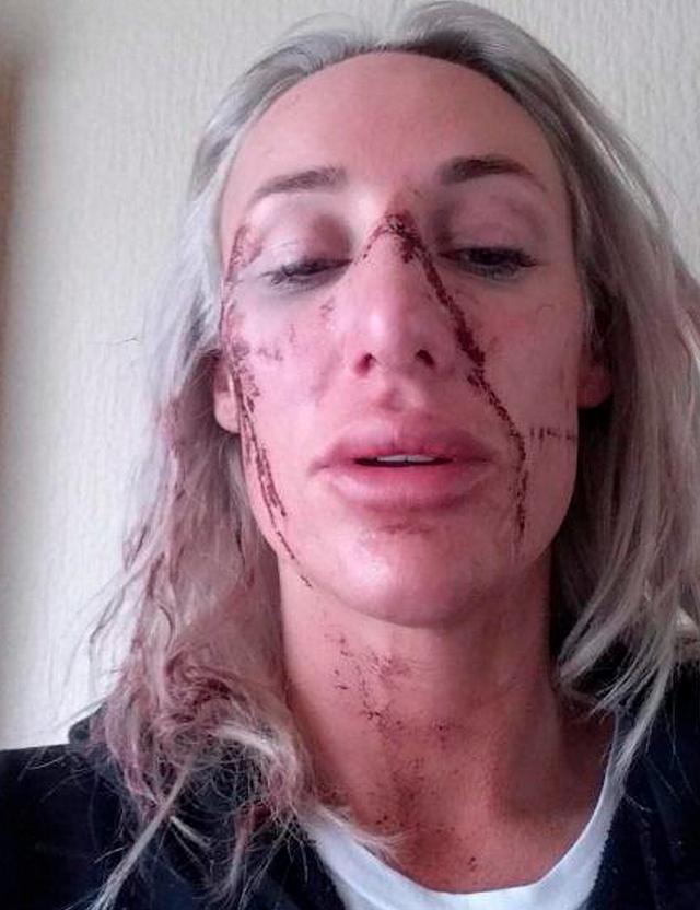Vết thương nghiêm trọng do bị tình cũ bạo hành trên mặt Carin