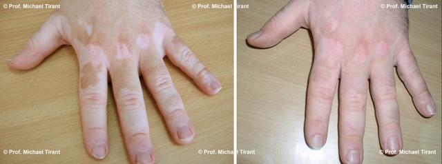 
Trước và sau 12 tuần sử dụng sản phẩm Dr Michaels Vitilinex từ thảo dược.

