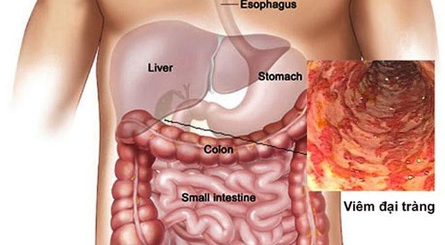 Viêm đại tràng nếu không phát hiện, điều trị kịp thời sẽ gây ung thư đại trực tràng.