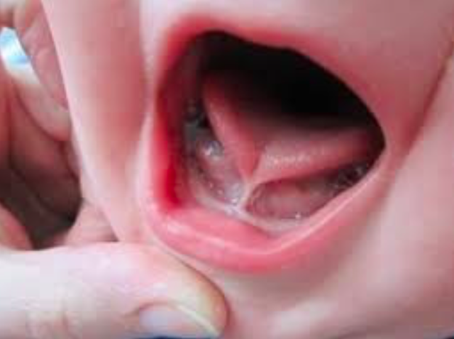 Khi bị dính thắng lưỡi, trẻ dễ phát âm sai các phụ âm: r, s, z.