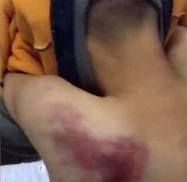 Vết bầm tr&ecirc;n lưng do bị đ&aacute;nh bằng 4 c&acirc;y chổi.