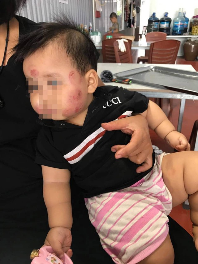 Mặt ch&aacute;u M k&iacute;n những vết thương